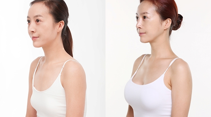Kem nở ngực có tốt không? Có nên dùng kem nở ngực không? Kem nở ngực có tốt không? Có nên dùng kem nở ngực không?