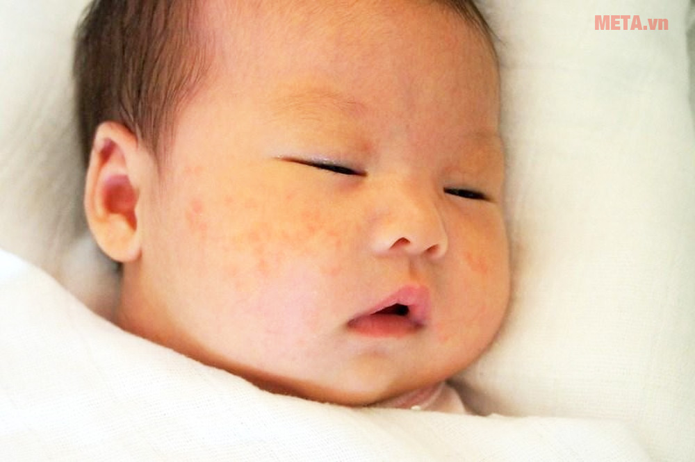 Nên cho bé ăn dặm lúc mấy tháng tuổi? Ăn dặm có lợi ích gì? Nguy cơ dị ứng thực phẩm