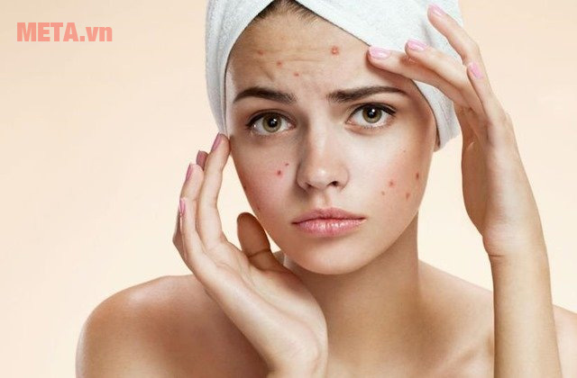 Học ngay những cách loại bỏ mụn trứng cá tại nhà Học ngay những cách loại bỏ mụn trứng cá tại nhà