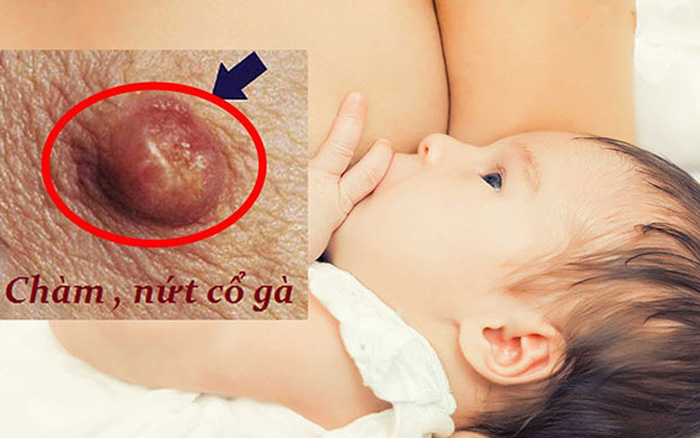 Nứt cổ gà xảy ra ở các mẹ bỉm sữa